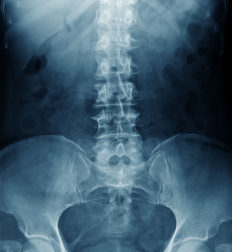 Bone Mineral Density